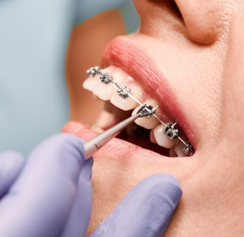 Orthodontic Braces